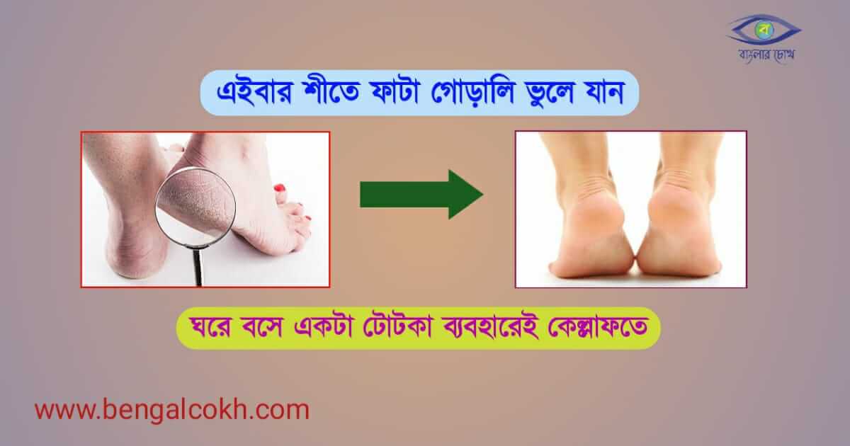 Crack Heels বা ফাটা গড়ালি